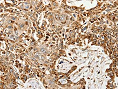 The image on the left is immunohistochemistry of paraffin-embedded Human esophagus cancer tissue using CSB-PA261251(SLC9A7 Antibody) at dilution 1/60, on the right is treated with synthetic peptide. (Original magnification: ×200)