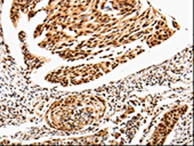 The image is immunohistochemistry of paraffin-embedded Human cervical cancer tissue using CSB-PA261295(ANGPTL4 Antibody) at dilution 1/25. (Original magnification: ×200)