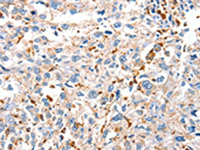 The image on the left is immunohistochemistry of paraffin-embedded Human esophagus cancer tissue using CSB-PA261651(DUSP14 Antibody) at dilution 1/20, on the right is treated with fusion protein. (Original magnification: ×200)