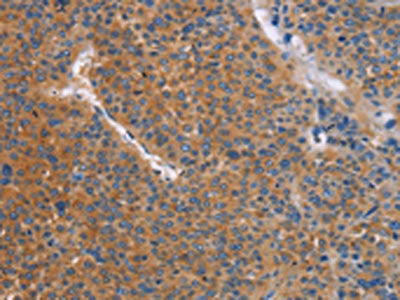 The image on the left is immunohistochemistry of paraffin-embedded Human liver cancer tissue using CSB-PA261777(TLR8 Antibody) at dilution 1/25, on the right is treated with fusion protein. (Original magnification: ×200)