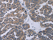 The image on the left is immunohistochemistry of paraffin-embedded Human ovarian cancer tissue using CSB-PA261892(TP53AIP1 Antibody) at dilution 1/50, on the right is treated with synthetic peptide. (Original magnification: ×200)