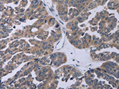 The image on the left is immunohistochemistry of paraffin-embedded Human ovarian cancer tissue using CSB-PA261892(TP53AIP1 Antibody) at dilution 1/50, on the right is treated with synthetic peptide. (Original magnification: ×200)