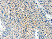 The image on the left is immunohistochemistry of paraffin-embedded Human liver cancer tissue using CSB-PA262006(TPM2 Antibody) at dilution 1/60, on the right is treated with synthetic peptide. (Original magnification: ×200)