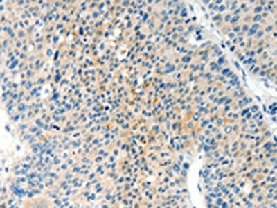 The image on the left is immunohistochemistry of paraffin-embedded Human liver cancer tissue using CSB-PA262006(TPM2 Antibody) at dilution 1/60, on the right is treated with synthetic peptide. (Original magnification: ×200)