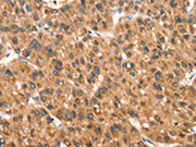 The image on the left is immunohistochemistry of paraffin-embedded Human liver cancer tissue using CSB-PA262326(DAP Antibody) at dilution 1/40, on the right is treated with synthetic peptide. (Original magnification: ×200)
