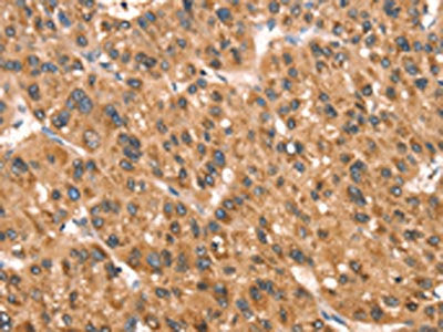 The image on the left is immunohistochemistry of paraffin-embedded Human liver cancer tissue using CSB-PA262326(DAP Antibody) at dilution 1/40, on the right is treated with synthetic peptide. (Original magnification: ×200)