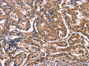 The image on the left is immunohistochemistry of paraffin-embedded Human breast cancer tissue using CSB-PA262509(MAP3K2 Antibody) at dilution 1/20, on the right is treated with synthetic peptide. (Original magnification: ×200)