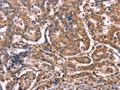 The image on the left is immunohistochemistry of paraffin-embedded Human breast cancer tissue using CSB-PA262509(MAP3K2 Antibody) at dilution 1/20, on the right is treated with synthetic peptide. (Original magnification: ×200)