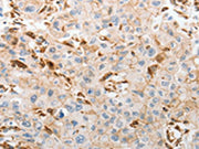 The image on the left is immunohistochemistry of paraffin-embedded Human lung cancer tissue using CSB-PA262561(SLC15A2 Antibody) at dilution 1/60, on the right is treated with synthetic peptide. (Original magnification: ×200)