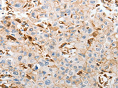 The image on the left is immunohistochemistry of paraffin-embedded Human lung cancer tissue using CSB-PA262561(SLC15A2 Antibody) at dilution 1/60, on the right is treated with synthetic peptide. (Original magnification: ×200)