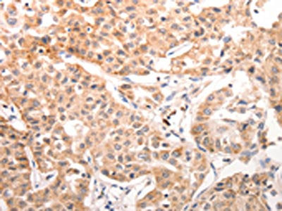 The image on the left is immunohistochemistry of paraffin-embedded Human lung cancer tissue using CSB-PA262645(CCR3 Antibody) at dilution 1/40, on the right is treated with synthetic peptide. (Original magnification: ×200)