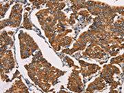 The image on the left is immunohistochemistry of paraffin-embedded Human breast cancer tissue using CSB-PA262747(SPR Antibody) at dilution 1/40, on the right is treated with synthetic peptide. (Original magnification: ×200)