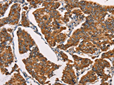 The image on the left is immunohistochemistry of paraffin-embedded Human breast cancer tissue using CSB-PA262747(SPR Antibody) at dilution 1/40, on the right is treated with synthetic peptide. (Original magnification: ×200)
