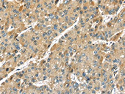 The image on the left is immunohistochemistry of paraffin-embedded Human liver cancer tissue using CSB-PA262991(TMPRSS11D Antibody) at dilution 1/35, on the right is treated with fusion protein. (Original magnification: ×200)