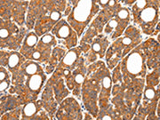 The image on the left is immunohistochemistry of paraffin-embedded Human thyroid cancer tissue using CSB-PA263065(ZNF281 Antibody) at dilution 1/35, on the right is treated with synthetic peptide. (Original magnification: ×200)
