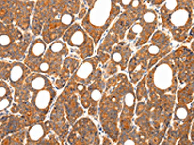 The image on the left is immunohistochemistry of paraffin-embedded Human thyroid cancer tissue using CSB-PA263065(ZNF281 Antibody) at dilution 1/35, on the right is treated with synthetic peptide. (Original magnification: ×200)