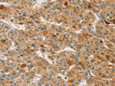 The image on the left is immunohistochemistry of paraffin-embedded Human liver cancer tissue using CSB-PA263066(TRIM40 Antibody) at dilution 1/40, on the right is treated with synthetic peptide. (Original magnification: ×200)