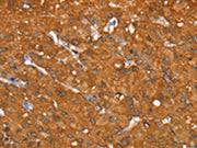 The image on the left is immunohistochemistry of paraffin-embedded Human liver cancer tissue using CSB-PA263631(AKR1C4 Antibody) at dilution 1/25, on the right is treated with fusion protein. (Original magnification: ×200)