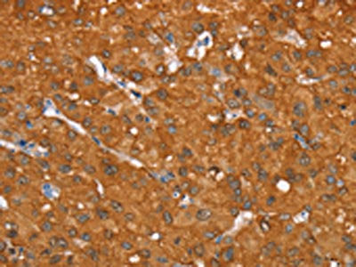 The image on the left is immunohistochemistry of paraffin-embedded Human liver cancer tissue using CSB-PA263631(AKR1C4 Antibody) at dilution 1/25, on the right is treated with fusion protein. (Original magnification: ×200)