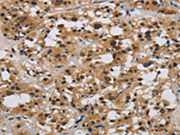 The image on the left is immunohistochemistry of paraffin-embedded Human thyroid cancer tissue using CSB-PA263795(E2F4 Antibody) at dilution 1/40, on the right is treated with synthetic peptide. (Original magnification: ×200)