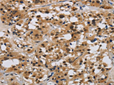 The image on the left is immunohistochemistry of paraffin-embedded Human thyroid cancer tissue using CSB-PA263795(E2F4 Antibody) at dilution 1/40, on the right is treated with synthetic peptide. (Original magnification: ×200)