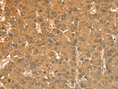 The image on the left is immunohistochemistry of paraffin-embedded Human liver cancer tissue using CSB-PA263860(CXCR4 Antibody) at dilution 1/50, on the right is treated with fusion protein. (Original magnification: ×200)