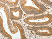 The image on the left is immunohistochemistry of paraffin-embedded Human colon cancer tissue using CSB-PA263919(AKR1B1 Antibody) at dilution 1/30, on the right is treated with synthetic peptide. (Original magnification: ×200)