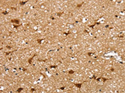 The image on the left is immunohistochemistry of paraffin-embedded Human brain tissue using CSB-PA264195(SSBP4 Antibody) at dilution 1/25, on the right is treated with fusion protein. (Original magnification: ×200)