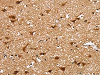 The image on the left is immunohistochemistry of paraffin-embedded Human brain tissue using CSB-PA264195(SSBP4 Antibody) at dilution 1/25, on the right is treated with fusion protein. (Original magnification: ×200)