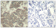Immunohistochemical analysis of paraffin-embedded human breast carcinoma tissue using Jak2(Ab-570) Antibody(left) or the same antibody preincubated with blocking peptide(right).