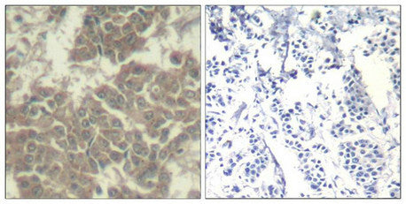 Immunohistochemical analysis of paraffin-embedded human breast carcinoma tissue using Jak2(Ab-570) Antibody(left) or the same antibody preincubated with blocking peptide(right).
