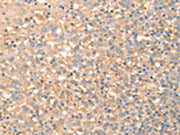 The image on the left is immunohistochemistry of paraffin-embedded Human tonsil tissue using CSB-PA264705(SLC4A7 Antibody) at dilution 1/20, on the right is treated with synthetic peptide. (Original magnification: ×200)