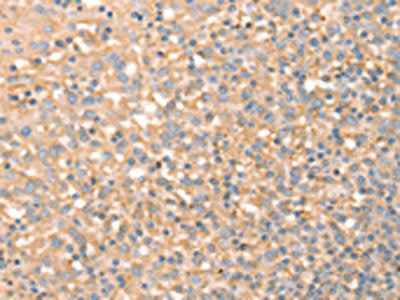 The image on the left is immunohistochemistry of paraffin-embedded Human tonsil tissue using CSB-PA264705(SLC4A7 Antibody) at dilution 1/20, on the right is treated with synthetic peptide. (Original magnification: ×200)