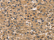 The image on the left is immunohistochemistry of paraffin-embedded Human liver cancer tissue using CSB-PA264762(TMSB4X Antibody) at dilution 1/30, on the right is treated with synthetic peptide. (Original magnification: ×200)