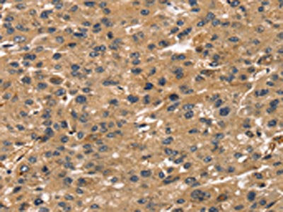 The image on the left is immunohistochemistry of paraffin-embedded Human liver cancer tissue using CSB-PA264762(TMSB4X Antibody) at dilution 1/30, on the right is treated with synthetic peptide. (Original magnification: ×200)