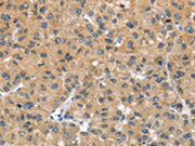 The image on the left is immunohistochemistry of paraffin-embedded Human liver cancer tissue using CSB-PA265027(UCP3 Antibody) at dilution 1/20, on the right is treated with synthetic peptide. (Original magnification: ×200)