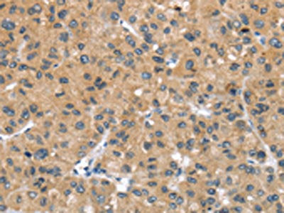 The image on the left is immunohistochemistry of paraffin-embedded Human liver cancer tissue using CSB-PA265027(UCP3 Antibody) at dilution 1/20, on the right is treated with synthetic peptide. (Original magnification: ×200)