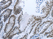 The image on the left is immunohistochemistry of paraffin-embedded Human colon cancer tissue using CSB-PA265034(RBMS1 Antibody) at dilution 1/30, on the right is treated with synthetic peptide. (Original magnification: ×200)