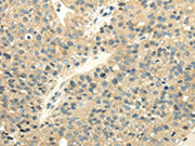 The image on the left is immunohistochemistry of paraffin-embedded Human breast cancer tissue using CSB-PA265121(UBL4A Antibody) at dilution 1/40, on the right is treated with fusion protein. (Original magnification: ×200)