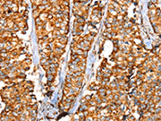 The image on the left is immunohistochemistry of paraffin-embedded Human breast cancer tissue using CSB-PA265169(SLC25A3 Antibody) at dilution 1/35, on the right is treated with synthetic peptide. (Original magnification: ×200)