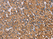 The image on the left is immunohistochemistry of paraffin-embedded Human liver cancer tissue using CSB-PA265524(RMDN3 Antibody) at dilution 1/25, on the right is treated with fusion protein. (Original magnification: ×200)