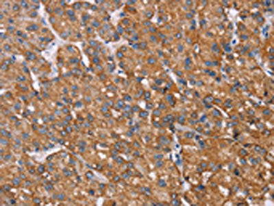 The image on the left is immunohistochemistry of paraffin-embedded Human liver cancer tissue using CSB-PA265524(RMDN3 Antibody) at dilution 1/25, on the right is treated with fusion protein. (Original magnification: ×200)