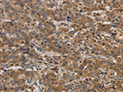 The image on the left is immunohistochemistry of paraffin-embedded Human liver cancer tissue using CSB-PA265650(RAB22A Antibody) at dilution 1/20, on the right is treated with synthetic peptide. (Original magnification: ×200)