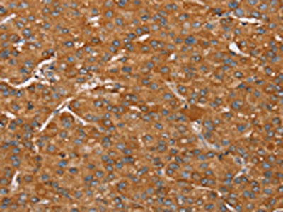 The image on the left is immunohistochemistry of paraffin-embedded Human liver cancer tissue using CSB-PA265728(PAGE5 Antibody) at dilution 1/55, on the right is treated with fusion protein. (Original magnification: ×200)