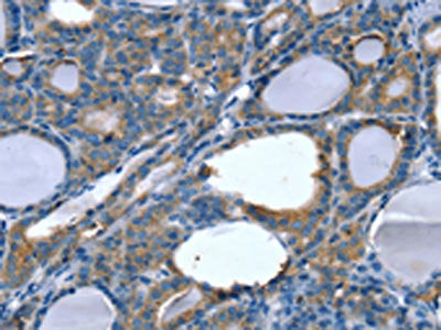The image on the left is immunohistochemistry of paraffin-embedded Human thyroid cancer tissue using CSB-PA265780(SLITRK4 Antibody) at dilution 1/20, on the right is treated with fusion protein. (Original magnification: ×200)