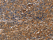 The image on the left is immunohistochemistry of paraffin-embedded Human Lymphoma tissue using CSB-PA265884(CCR5 Antibody) at dilution 1/20, on the right is treated with synthetic peptide. (Original magnification: ×200)