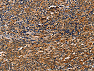 The image on the left is immunohistochemistry of paraffin-embedded Human Lymphoma tissue using CSB-PA265884(CCR5 Antibody) at dilution 1/20, on the right is treated with synthetic peptide. (Original magnification: ×200)