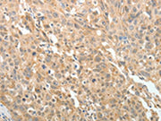 The image on the left is immunohistochemistry of paraffin-embedded Human ovarian cancer tissue using CSB-PA265957(MAP4 Antibody) at dilution 1/10, on the right is treated with fusion protein. (Original magnification: ×200)