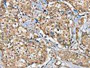 The image on the left is immunohistochemistry of paraffin-embedded Human breast cancer tissue using CSB-PA266237(SGPL1 Antibody) at dilution 1/40, on the right is treated with synthetic peptide. (Original magnification: ×200)