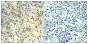 Immunohistochemical analysis of paraffin-embedded human lung carcinoma tissue using cofilin1(Phospho-Tyr139) Antibody(left) or the same antibody preincubated with blocking peptide(right).
